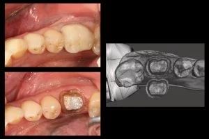 Digital impression of the tooth, the upper teeth, and the bite registration.